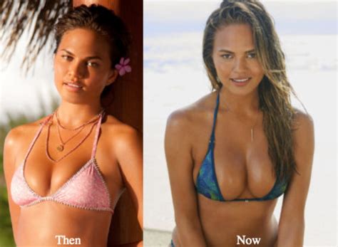 Chrissy Teigen Plastic Surgery Before And After Photos Latest Plastic