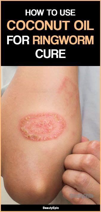 Home Remedies For Ringworm Polizshoe