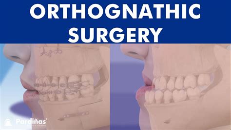 Orthognathic Surgery All About Jaw Realignment Surgery © Youtube