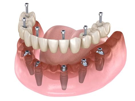 All On 6 Dental Implants San Diego Smile Designers San Diego
