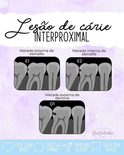 Dra Dentinhos Alice On Instagram 🦷 LesÃo De CÁrie Interproximal 🩻