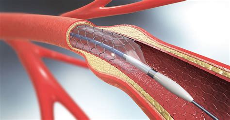 Tcar Reduces Stroke Risk During Carotid Artery Stenting Froedtert And Mcw