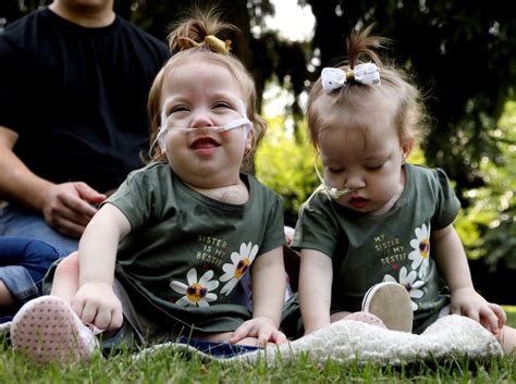 Michigan Conjoined Twins Sarabeth Amelia Irwin Successfully Separated