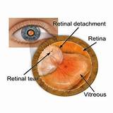 Treatment For Hole In Retina Of Eye Photos