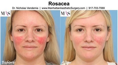 Ipl For Rosacea At Home Company Movers In Riyadh