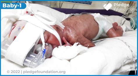 Born In 7 Months Keep These Premature Twins Alive