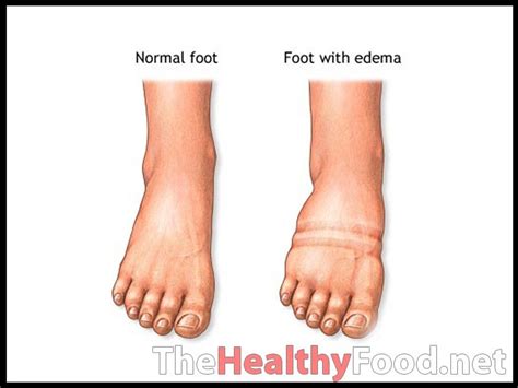 Are Your Ankles And Feet Swollen Then You May Have Ankle Oedema Podiatry Hq