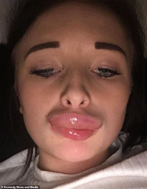 Billie Roocroft Claims A Filler Treatment Made Her Lips Double In Size