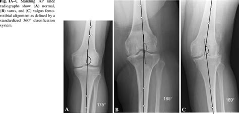 Ac Standing Ap Knee Radiographs Show A Normal B Varus And C