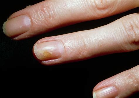 Tinea Fungal Infection Of A Womans Fingernail Photograph By Mike