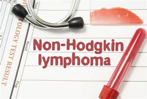 Early Warning Signs Of Non Hodgkins Lymphoma Healthfocus