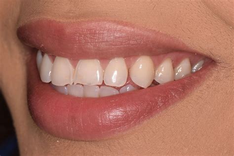 Before And After Composite Bonding And Smile Makeover Photos