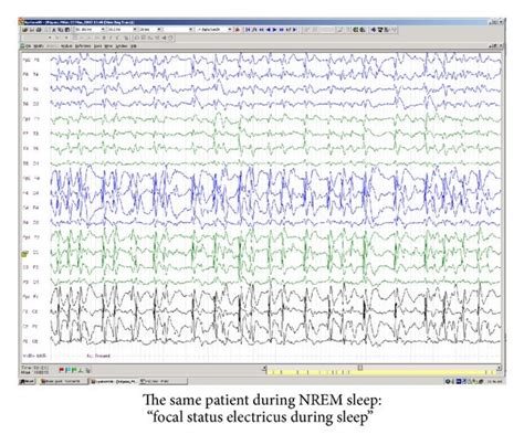Rolandic Epilepsy With Atypical Features Progressive Cognitive