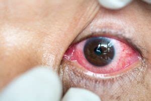 Have systemic antivirals made a herpes zoster ophthalmicus natural history, risk factors, clinical presentation, and morbidity. Shingles in the Eye (Herpes Zoster): Symptoms, Complications, & Treatments