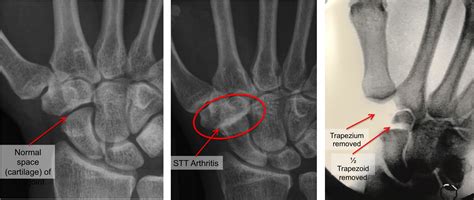 Thumb Arthritis Raleigh Hand Surgery — Joseph J Schreiber Md