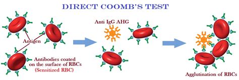 A blood sample must be drawn. Anti Human Globulin Test (Coomb's Test) - MedicoInfo