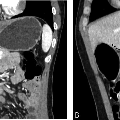 On Contrast Enhanced Coronal And Sagittal Computed Tomography Scans