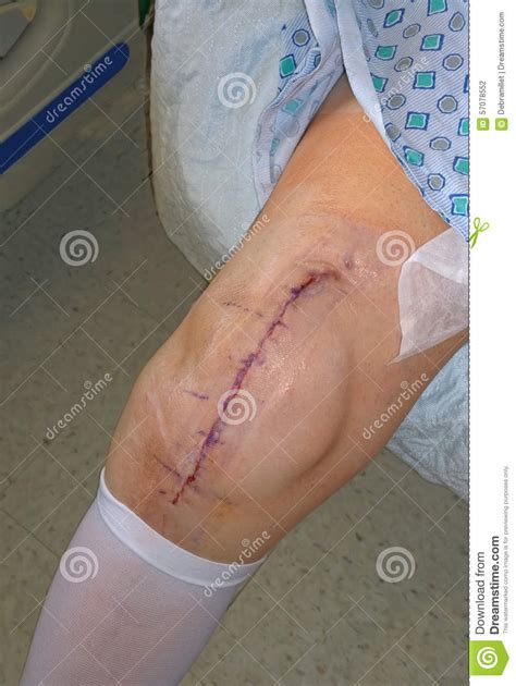 Choose from a wide range of similar scenes. Knee Replacement Surgery Scar Stock Photo - Image: 57078552