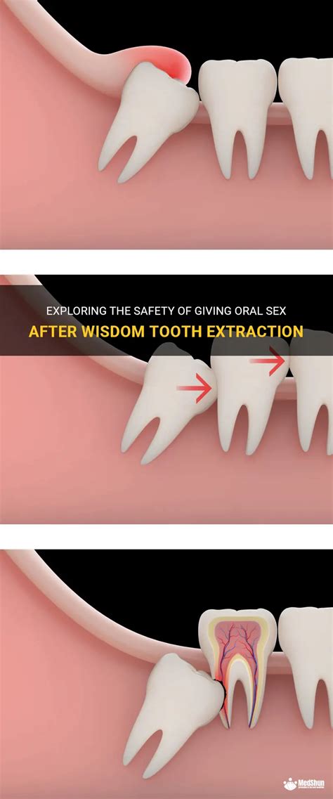 Exploring The Safety Of Giving Oral Sex After Wisdom Tooth Extraction Medshun