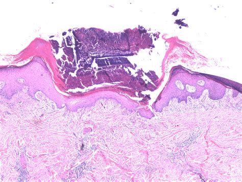 Photomicrograph Showing Compact Hyperkeratosis And Acanthosis Of The