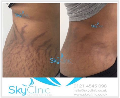 Stretch Marks Treatment After 3 Sessions Sky Clinic