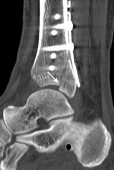 Posterior Pilon Fracture Epidemiology And Surgical Technique Injury