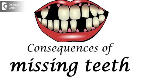 Consequences Of Missing Teeth Dr Srivats Bharadwaj Youtube