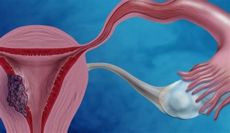 Células columnares y células escamosas. Cáncer de Endometrio: Qué es, Tipos, Causas, Síntomas ...