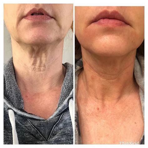 Microneedling After Care Sheet