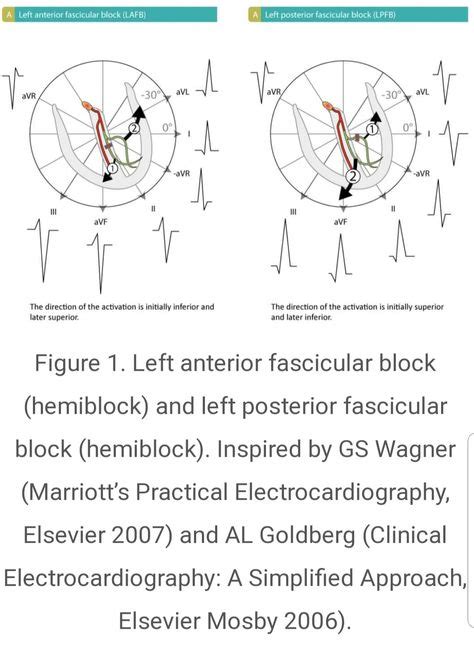 Fascicular Block Hemiblock Left Anterior And Left Posterior Fascicular