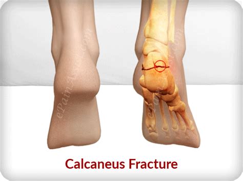 Calcaneus Fracture Or Broken Heeltreatmentrecoverysymptomstypescauses