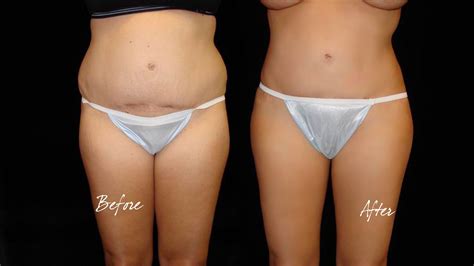 Pin On Liposuction Plastic Surgery