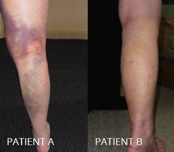 Pictures Of Bruising After Knee Replacement Surgery The Meta Pictures