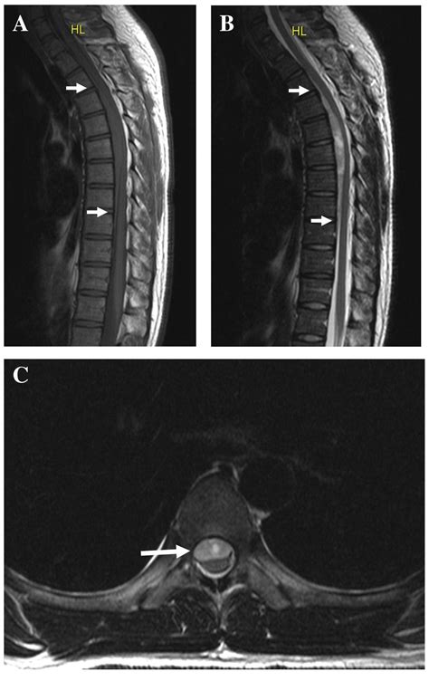 Complete Motor Recovery After Acute Paraparesis Caused By Spontaneous