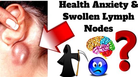 Health Anxiety And Swollen Lymph Nodes Youtube