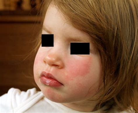 Slapped Cheek Syndrome Pictures