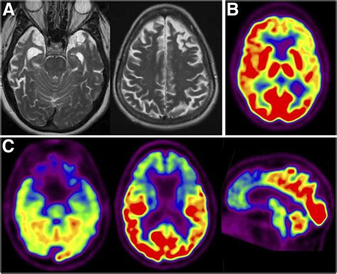 Multimodality Imaging Of Alzheimer Disease And Other Neurodegenerative