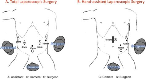 Trocar Placement In Total Laparoscopic Surgery A And Hand Assisted Download Scientific