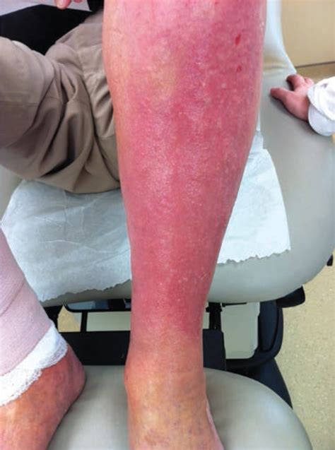 Mistaken Lower Extremity Dermatitis