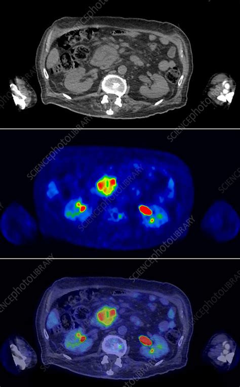 Pancreatic Cancer CT And PET Scan Stock Image C Science
