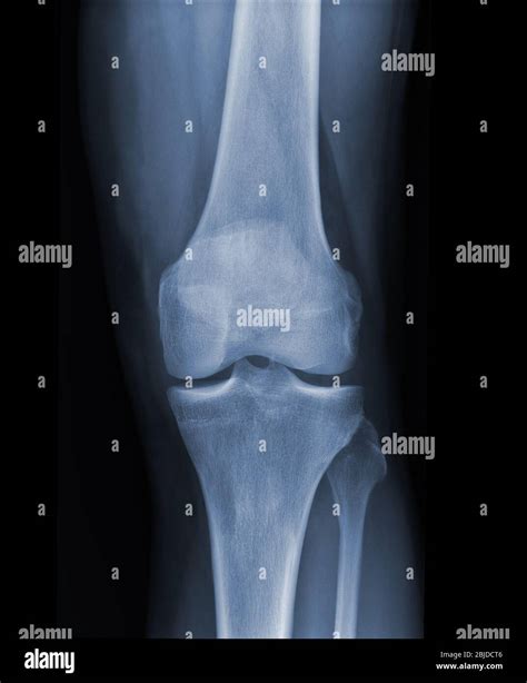 X Ray Knee Radiograph Show State Of Injury Stock Photo Alamy