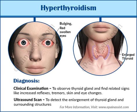 Hyperthyroidism Treatment Prevention Symptoms Causes