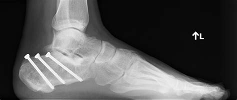 Calcaneus Fracture Broken Heel Bone Orthopaedic Trauma Association