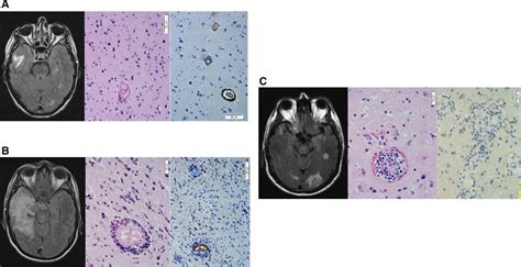 Inflammatory Cerebral Amyloid Angiopathy Amyloid βrelated Angiitis