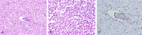 Malignant Rhabdoid Tumor Mrt With Glomerular Sparing Gs Pattern