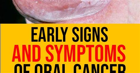 Mouth Cancer Symptoms Warning Signs