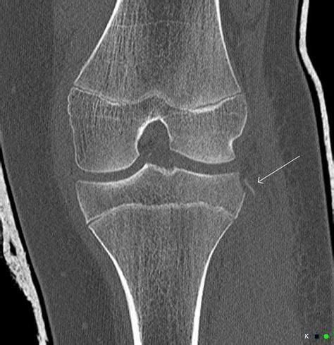 Tibial Spine Fracture Radiology
