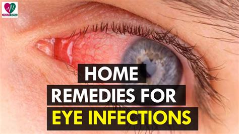 Home Remedies For Eye Infections Health Sutra Youtube