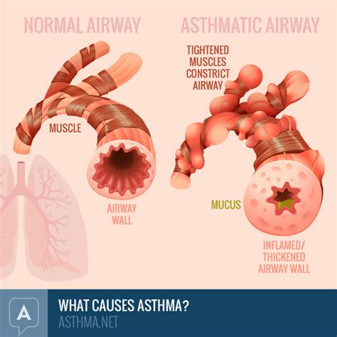 What Causes Asthma Inflammation And Airway Narrowing