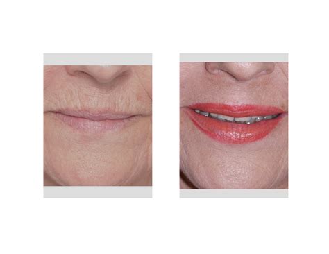 Upper Lip Wrinkles Difficult Problem Multiple Treatments Explore